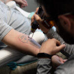 tatueringsborttagning underarm